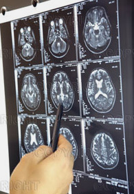 stroke training brain